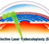 Selective Laser Trabeculoplasty (SLT)