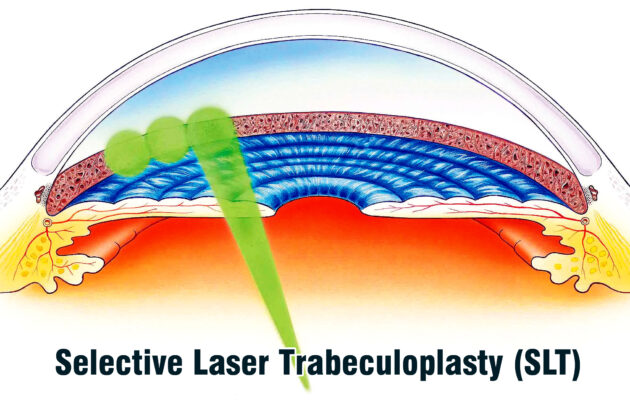 Selective Laser Trabeculoplasty (SLT)