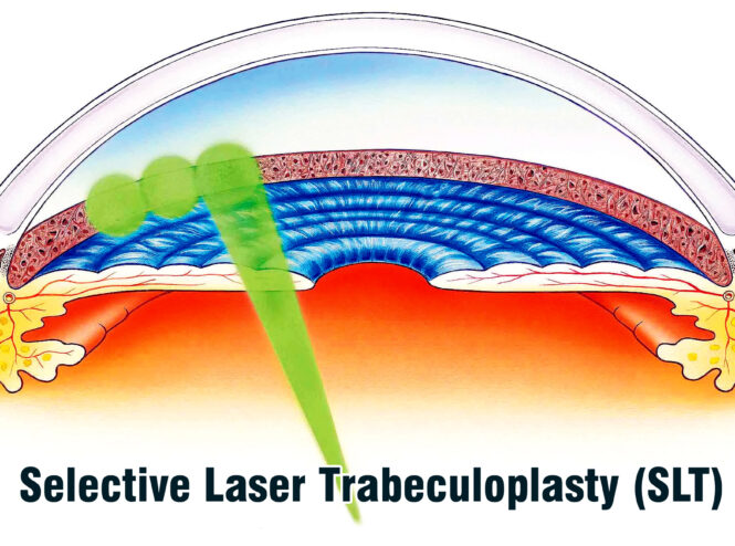 Selective Laser Trabeculoplasty (SLT)